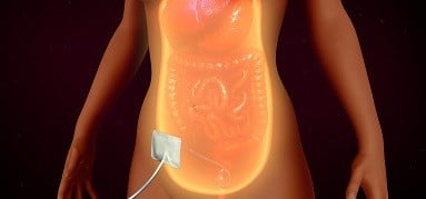 peritoneal dialysis 3d render