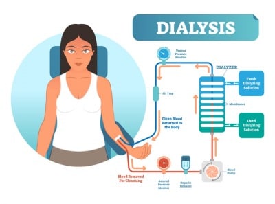 dialysis diagram illustration