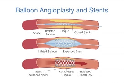 PAD treatment balloon angioplasty and stents diagram