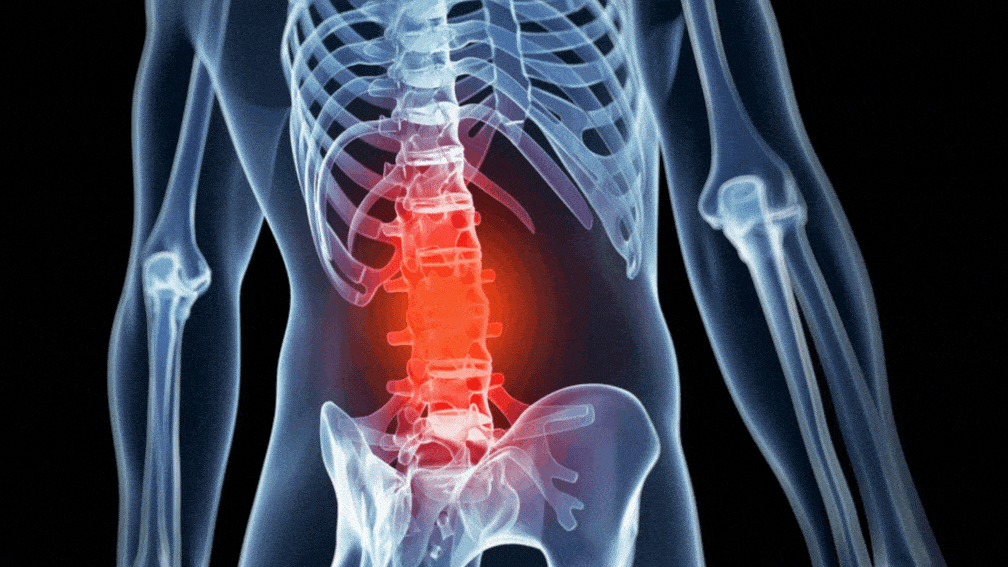 Compression Fractures